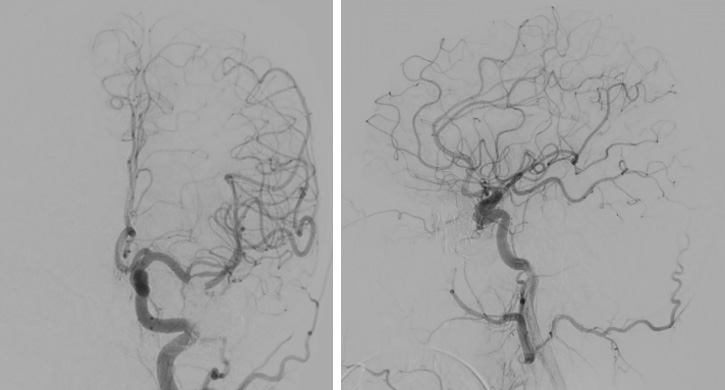 Multipouch Intraosseous DAVF Embolisation