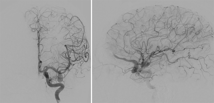 Multipouch Intraosseous DAVF Embolisation