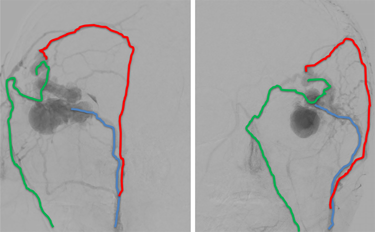 Multipouch Intraosseous DAVF Embolisation
