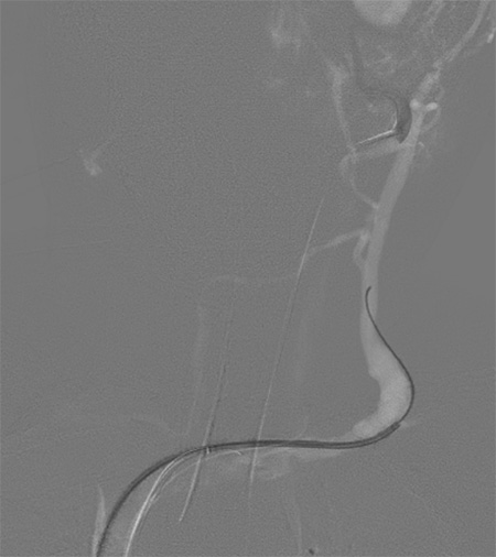 Multipouch Intraosseous DAVF Embolisation