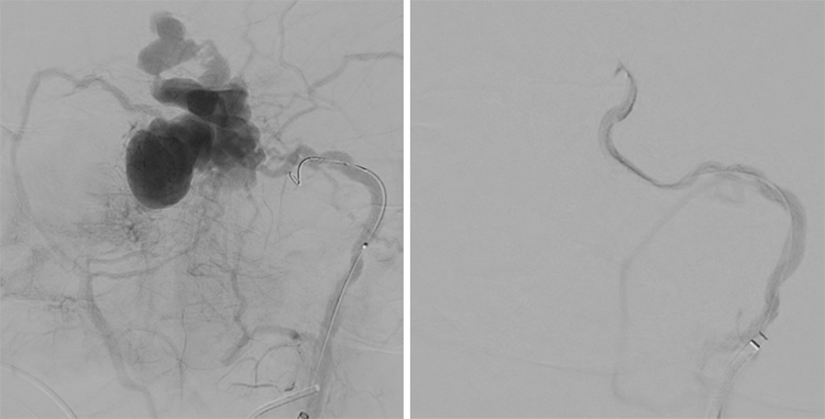 Multipouch Intraosseous DAVF Embolisation