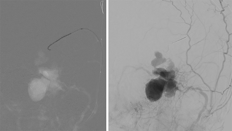 Multipouch Intraosseous DAVF Embolisation