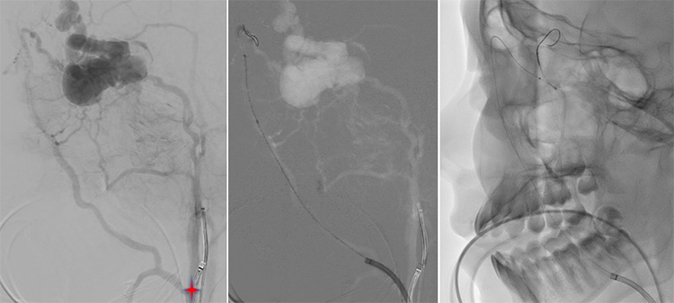 Multipouch Intraosseous DAVF Embolisation