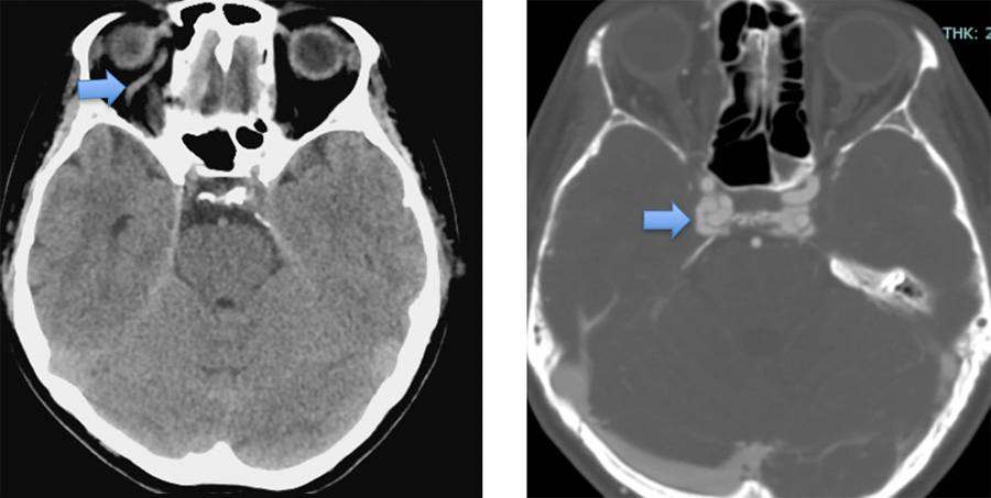 Osteodural dural arteriovenous fistula mimicking CCF
