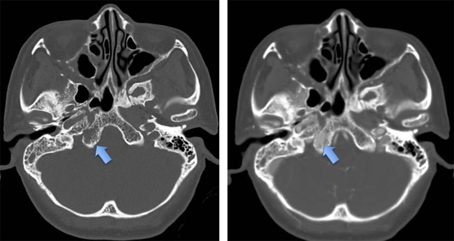 Osteodural dural arteriovenous fistula mimicking CCF