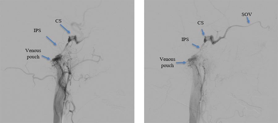 Osteodural dural arteriovenous fistula mimicking CCF
