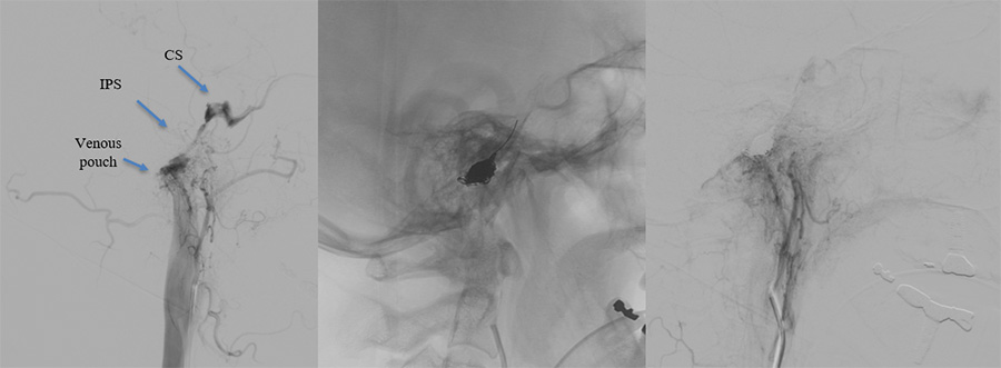 Osteodural dural arteriovenous fistula mimicking CCF
