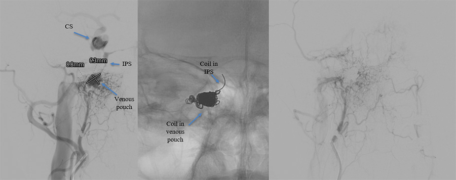 Osteodural dural arteriovenous fistula mimicking CCF