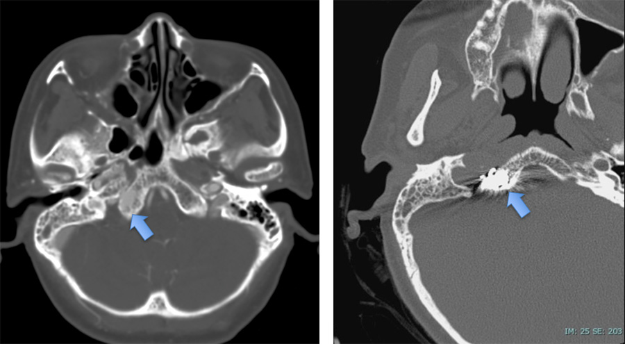 Osteodural dural arteriovenous fistula mimicking CCF