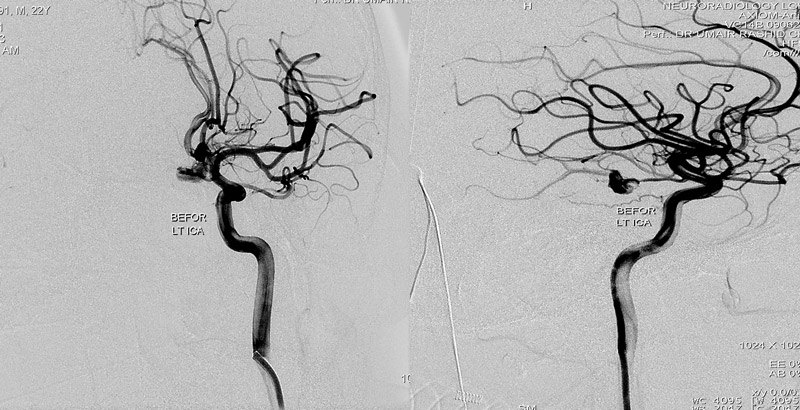 PCA Aneurysm