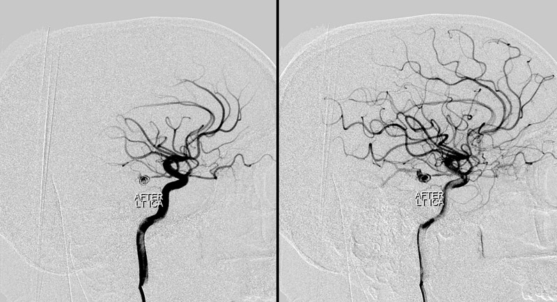 PCA Aneurysm