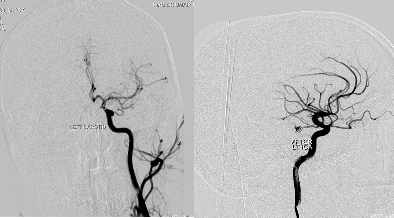 PCA Aneurysm