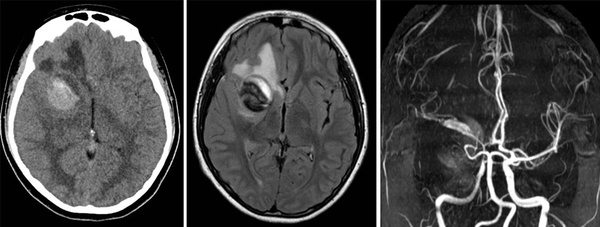 Partially thrombosed MCA/ ICA dissecting aneurysm