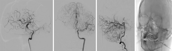 DSA shows a dissecting aneurysm involving the right ICA and MCA previous its bifurcation. TBO shows good leptomeningeal collaterals of the  M2 superior trunk.