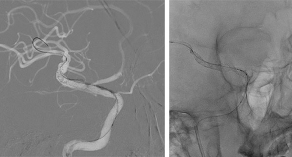 2 FD STENTS from the ICA to the inferior ramus M2