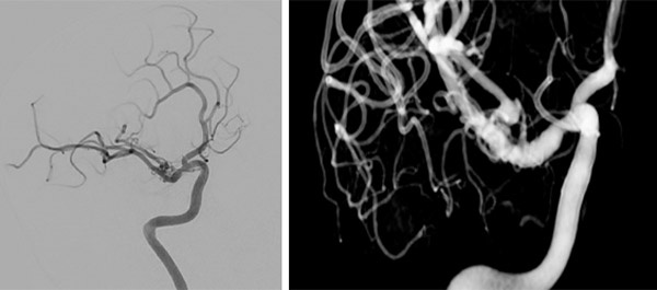 8 months FU/ Aneurysm rest in the superior M2 branch not covered by the FD Stent