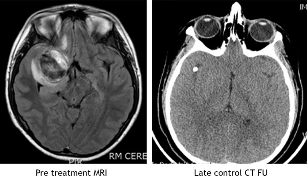 Pediatric-ICA-aneurysm-case-Image7