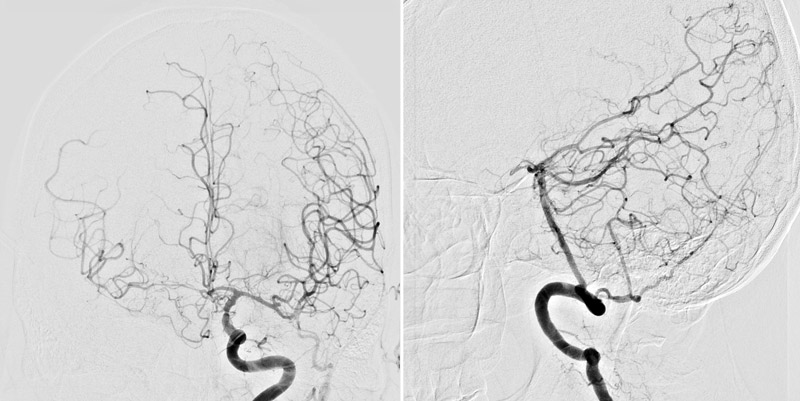 Poor circle of Willis collateral