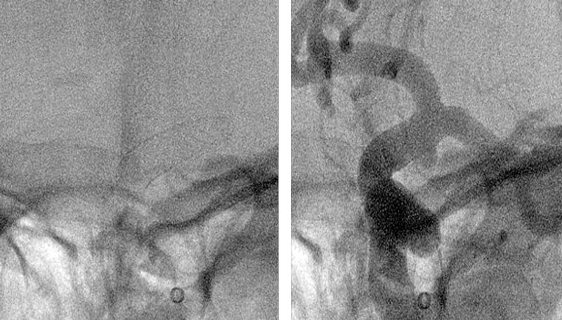 Post Deployment - Check Angiogram