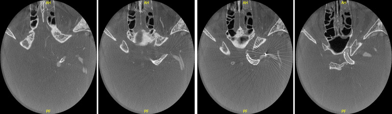 Post-Op Dyna CT
