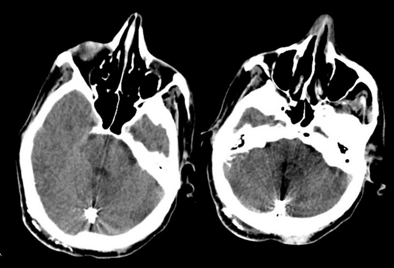 Post operative CT scan