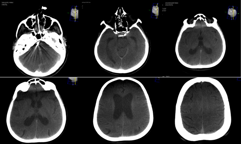 Post Procedure CT
