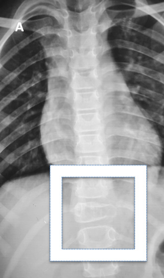 Pre-surgical Embolization followed by decompression in Atypical aggressive spinal hemangioma involving posterior elements