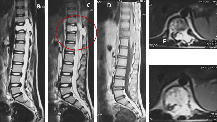 Pre-surgical Embolization followed by decompression in Atypical aggressive spinal hemangioma involving posterior elements
