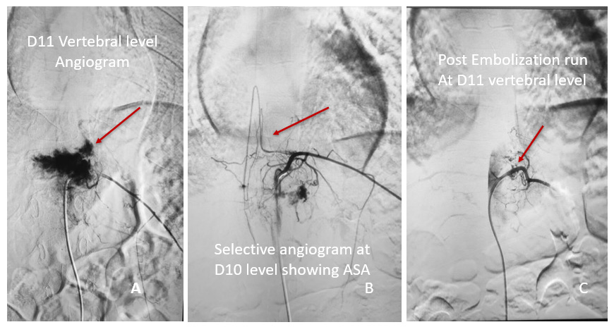 Pre-surgical Embolization followed by decompression in Atypical aggressive spinal hemangioma involving posterior elements