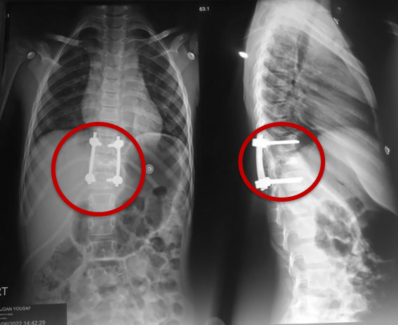 Pre-surgical Embolization followed by decompression in Atypical aggressive spinal hemangioma involving posterior elements