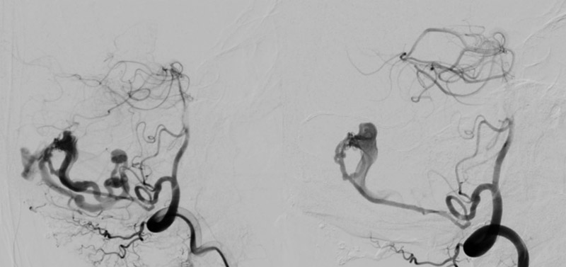 prominent PICA artery and fistula to vermian vein