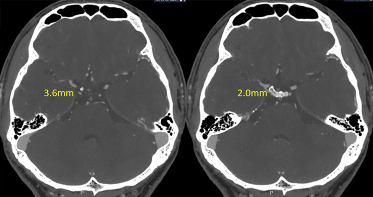 R-MCA occlusion, with satisfactory vessel bed of distal to occlusion