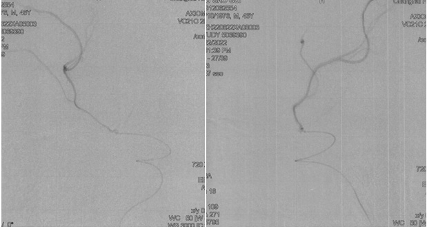 Recanalization of MCA-CTO after 2 years occlusion