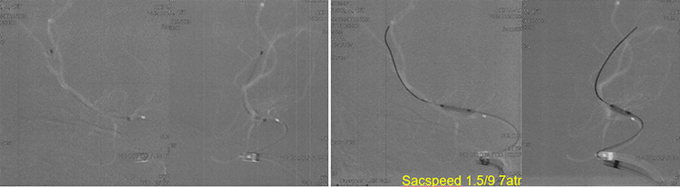Recanalization of MCA-CTO after 2 years occlusion