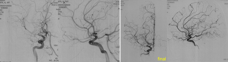Recanalization of MCA-CTO after 2 years occlusion