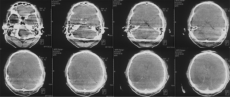 Recanalization of MCA-CTO after 2 years occlusion