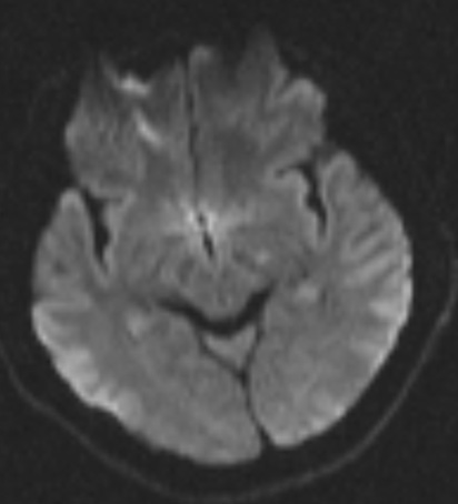 Recanalization of MCA-CTO after 2 years occlusion