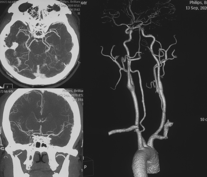 Recanalization of MCA-CTO after 2 years occlusion