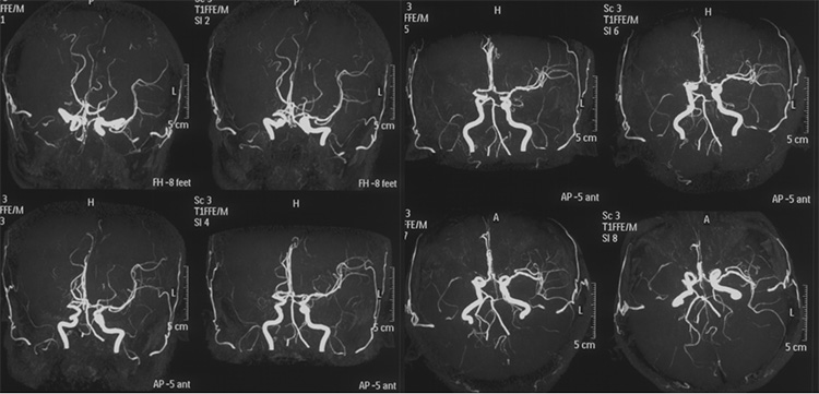 Recanalization of MCA-CTO after 2 years occlusion