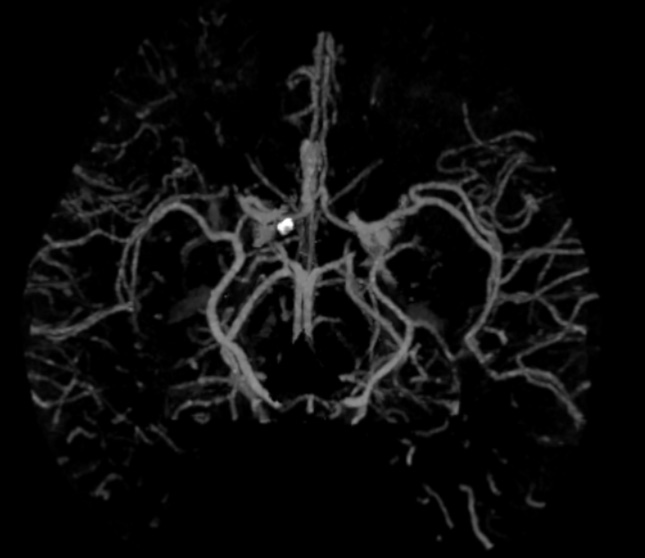 Recanalization of MCA-CTO after 2 years occlusion