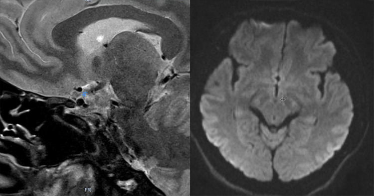 Recanalization of MCA-CTO after 2 years occlusion