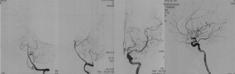 Recanalization of MCA-CTO after 2 years occlusion