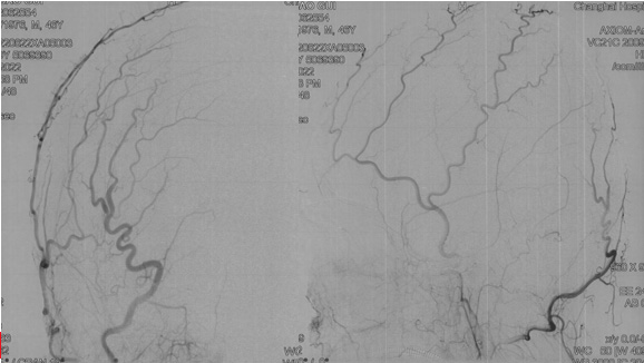Recanalization of MCA-CTO after 2 years occlusion