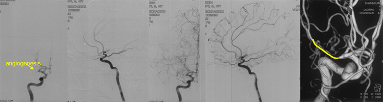 Recanalization of MCA-CTO after 2 years occlusion