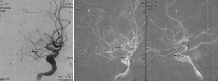Recanalization of MCA-CTO after 2 years occlusion