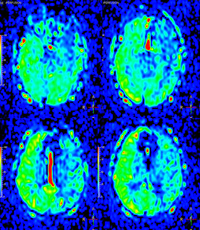Reduced perfusion signal along bilateral ACA and left MCA territories