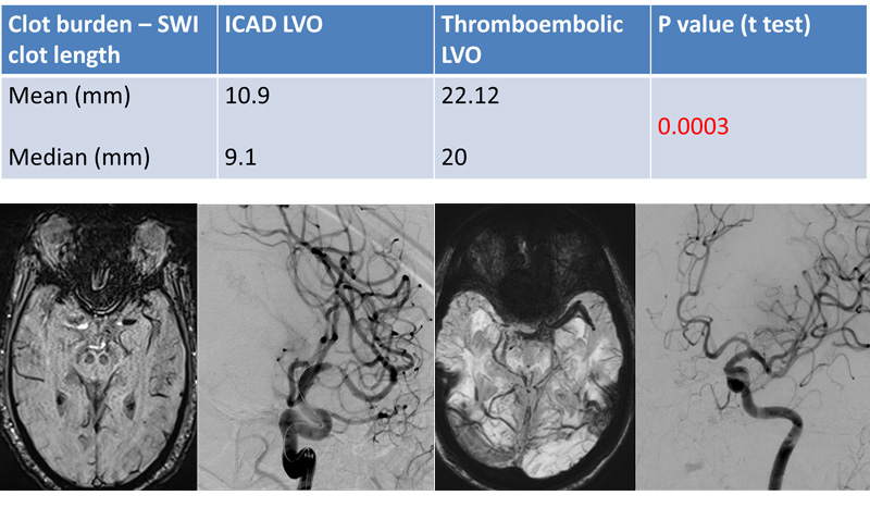 Results – Length of clot on SWI