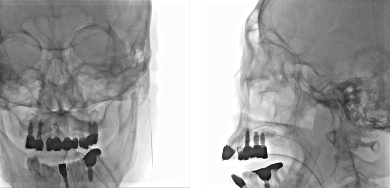Retrograde guidewire placement