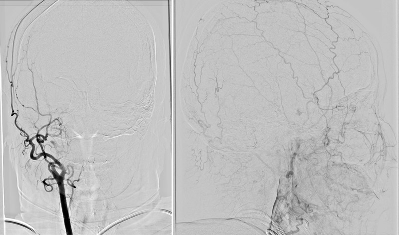 Right ICA occlusion