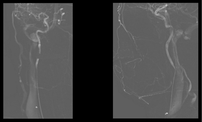 Right ICA roadmap demonstrating the venous drainage